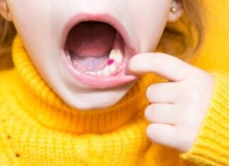 The Beauty of Tooth-Coloured Fillings tooth-colored fillings