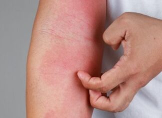 Lupus and Your Skin – All You Need to Know Explore Cutaneous Erythematosus Lupus Clinical Trials near you