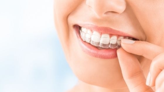 Invisalign braces cost in UK