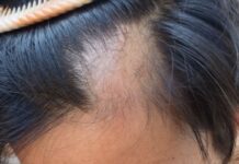 hair mesotherapy in Turkey