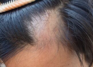 Benefits Of Hair Mesotherapy In Hair Loss Reduction hair mesotherapy in Turkey