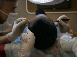 turkey hair transplant package