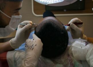 Loss of Hair in Women turkey hair transplant package