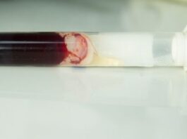 Blood Clots Diagnosed