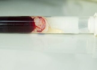 How Are Blood Clots Diagnosed With Diagnostics Tests? Blood Clots Diagnosed