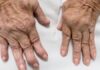 Can Regenerative Medicine Help You Get Rid of Arthritis