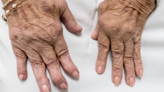 Can Regenerative Medicine Help You Get Rid of Arthritis