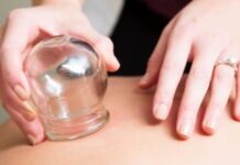 cupping therapy