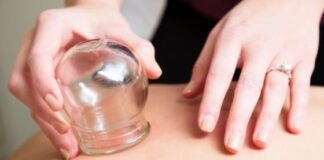 cupping therapy